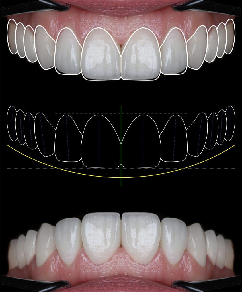Diseño digital de sonrisa